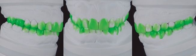 REHABILITACIÓN ORAL CON RFA