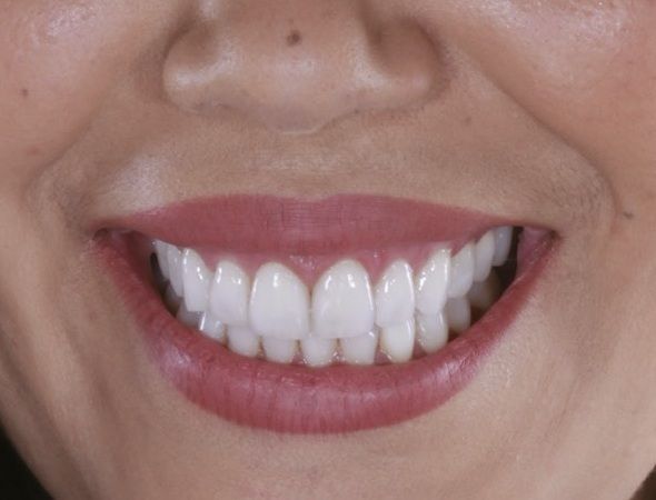 DIENTES-BONITOS-EN-UN-CUERPO-SANO