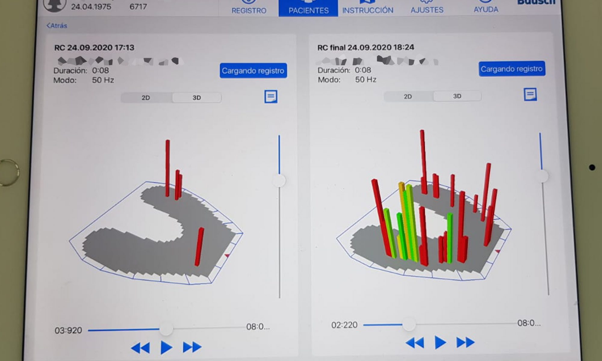 Equilibrado Oclusal, Remodelado plástico oclusal