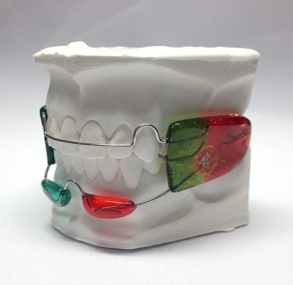 Fases de tratamiento con HBTC-RFA.