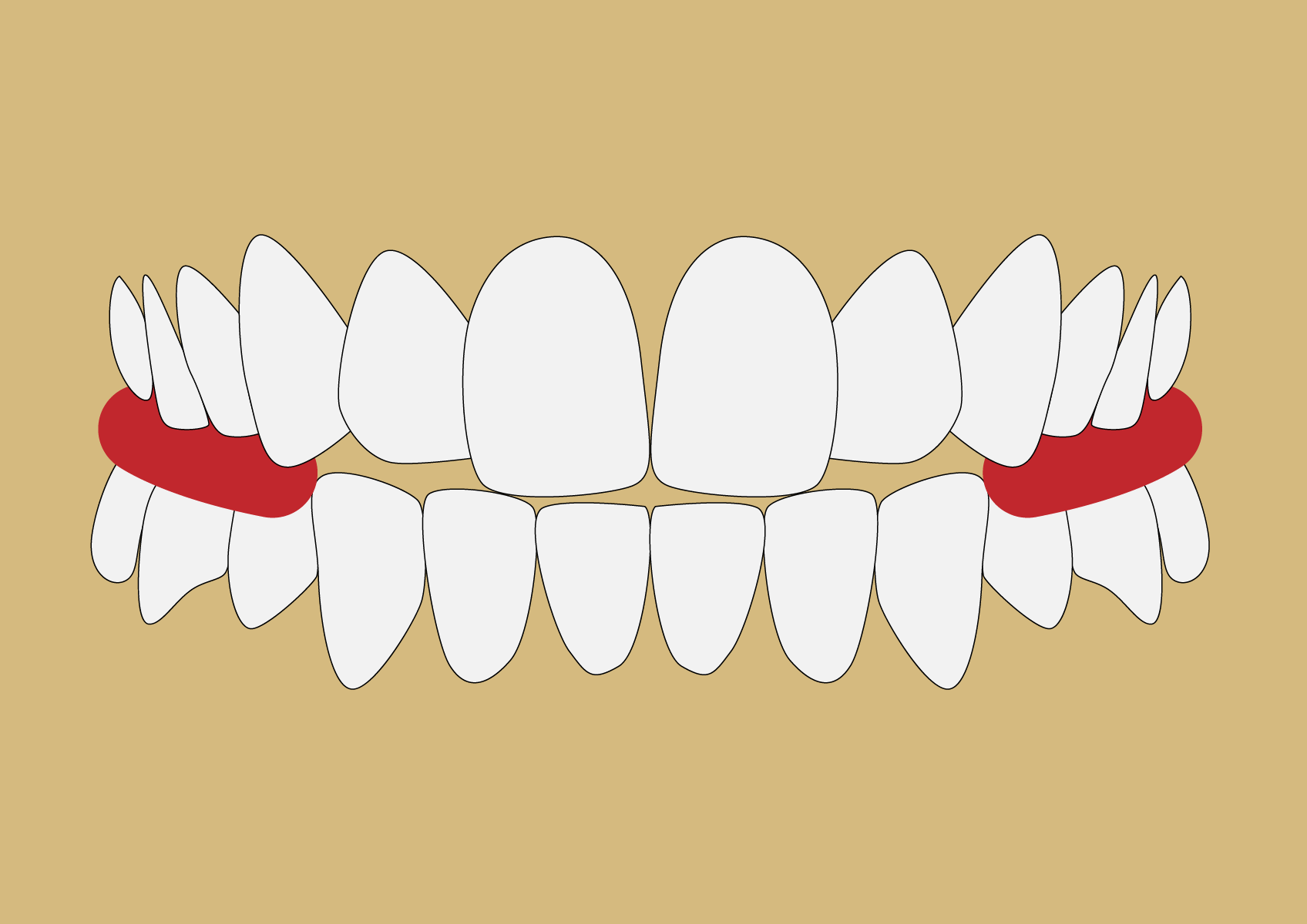 Test de Meersseman en odontología