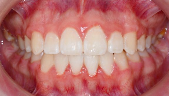 Disponemos para nuestros pacientes de la tecnología CEREC. Con impresiones digitales, planeamiento de reconstrucciones totalmente en cerámica y de rápida ejecución. Según las necesidades del paciente y la normativa sanitaria en vigor.