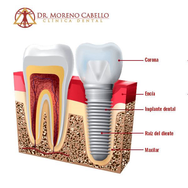 Materiales de Alta Compatibilidad en la Boca