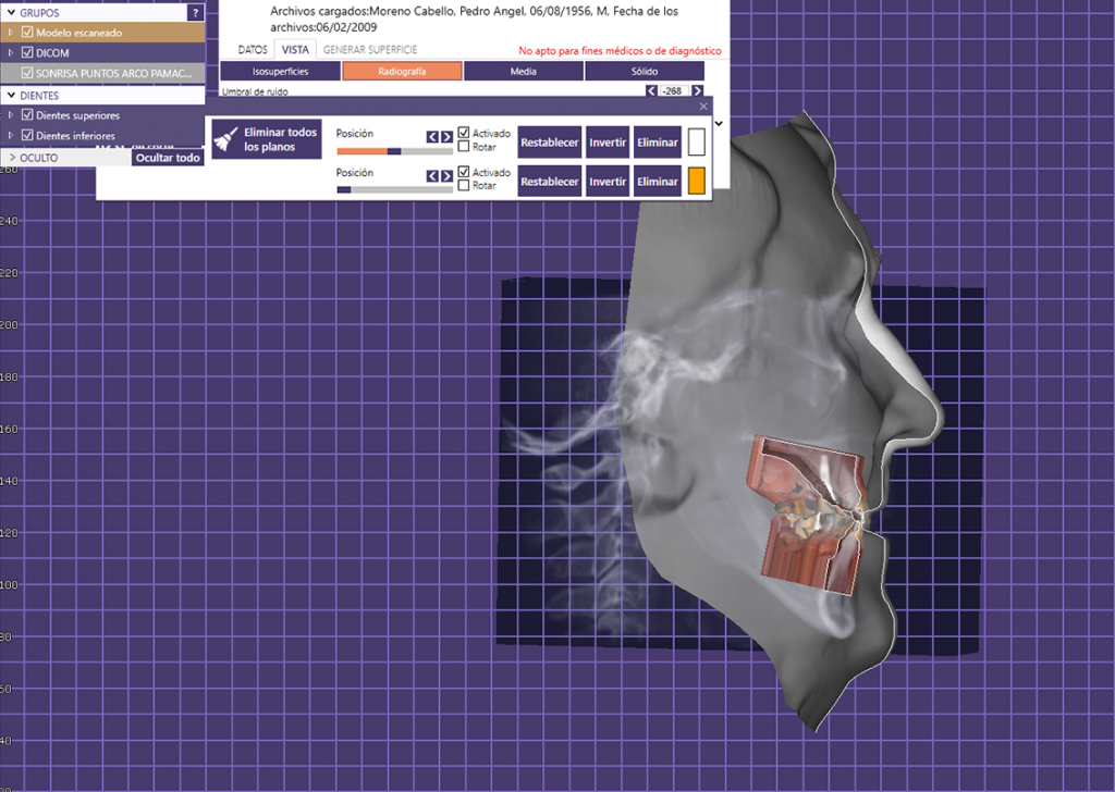 Articulador Dental Virtual (ADV)