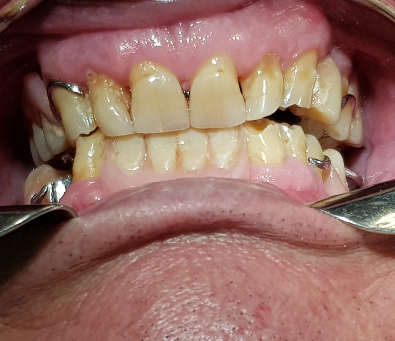 Indicaciones del equilibrado oclusal