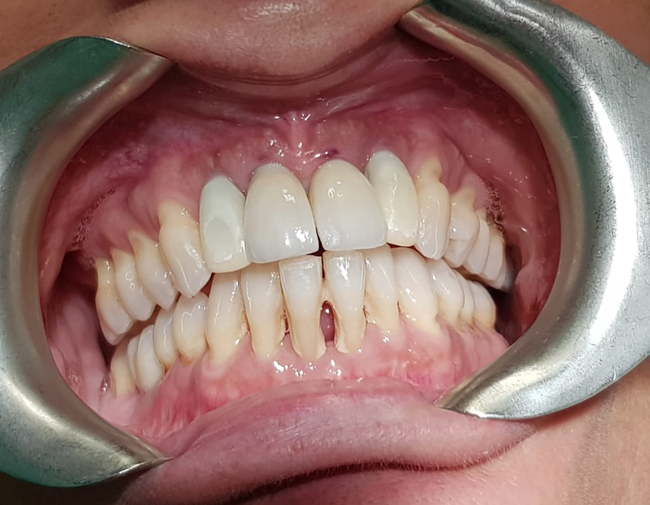 INDICACIONES DEL EQUILIBRADO OCLUSAL