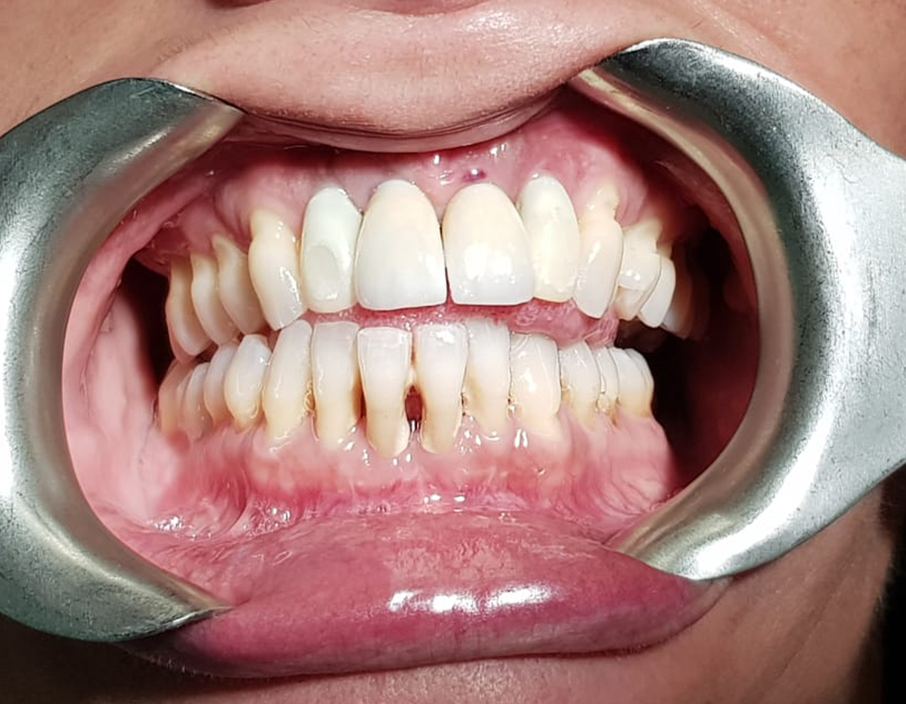 INDICACIONES DEL EQUILIBRADO OCLUSAL