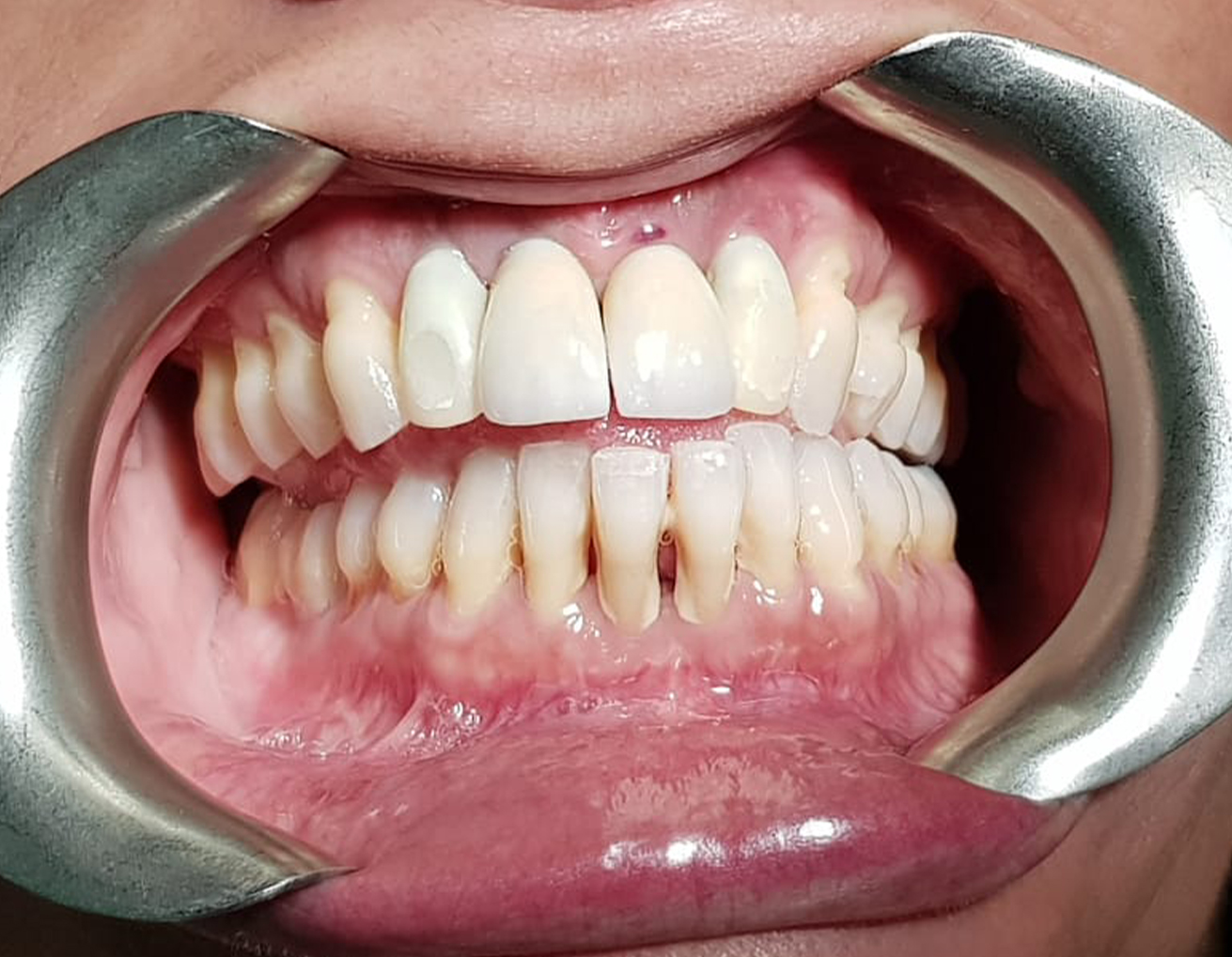 INDICACIONES DEL EQUILIBRADO OCLUSAL
