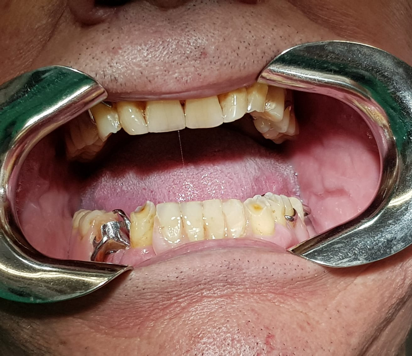 INDICACIONES DEL EQUILIBRADO OCLUSAL