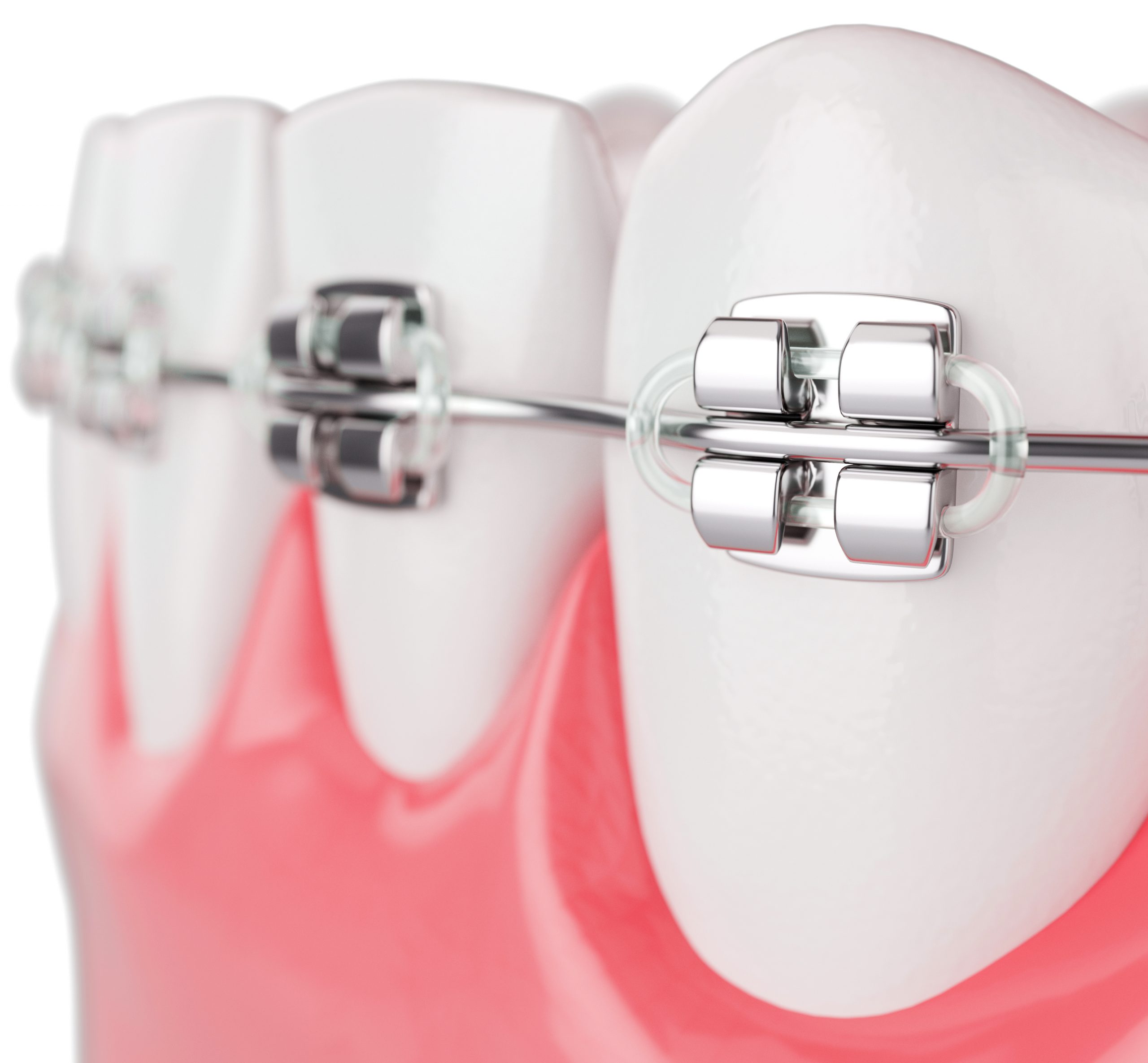 Brackets-clinicadentalmorenocabello